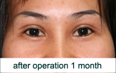 plastic-surgery-blepharoplasty